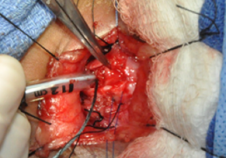 Exposing_posterior_cricoid_plate