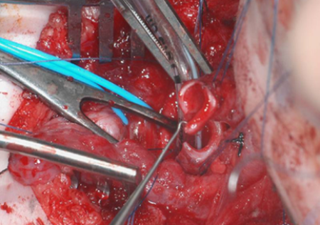 slide_tracheoplasty