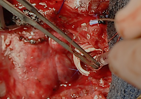 tracheal_reconstruction_agensis